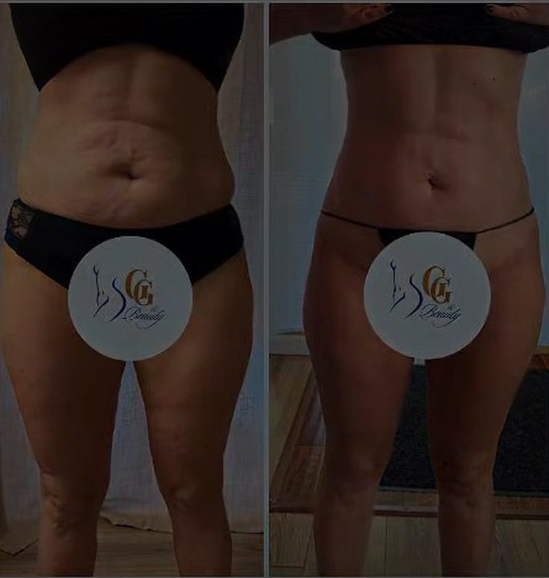 Body contouring before and after, real Glamorous Grinz & Beauty client