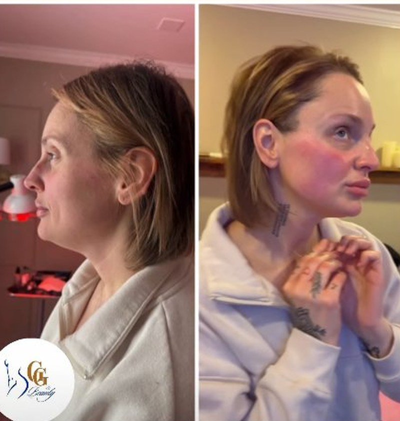 Plasma Showers face and jawline before and after, real client