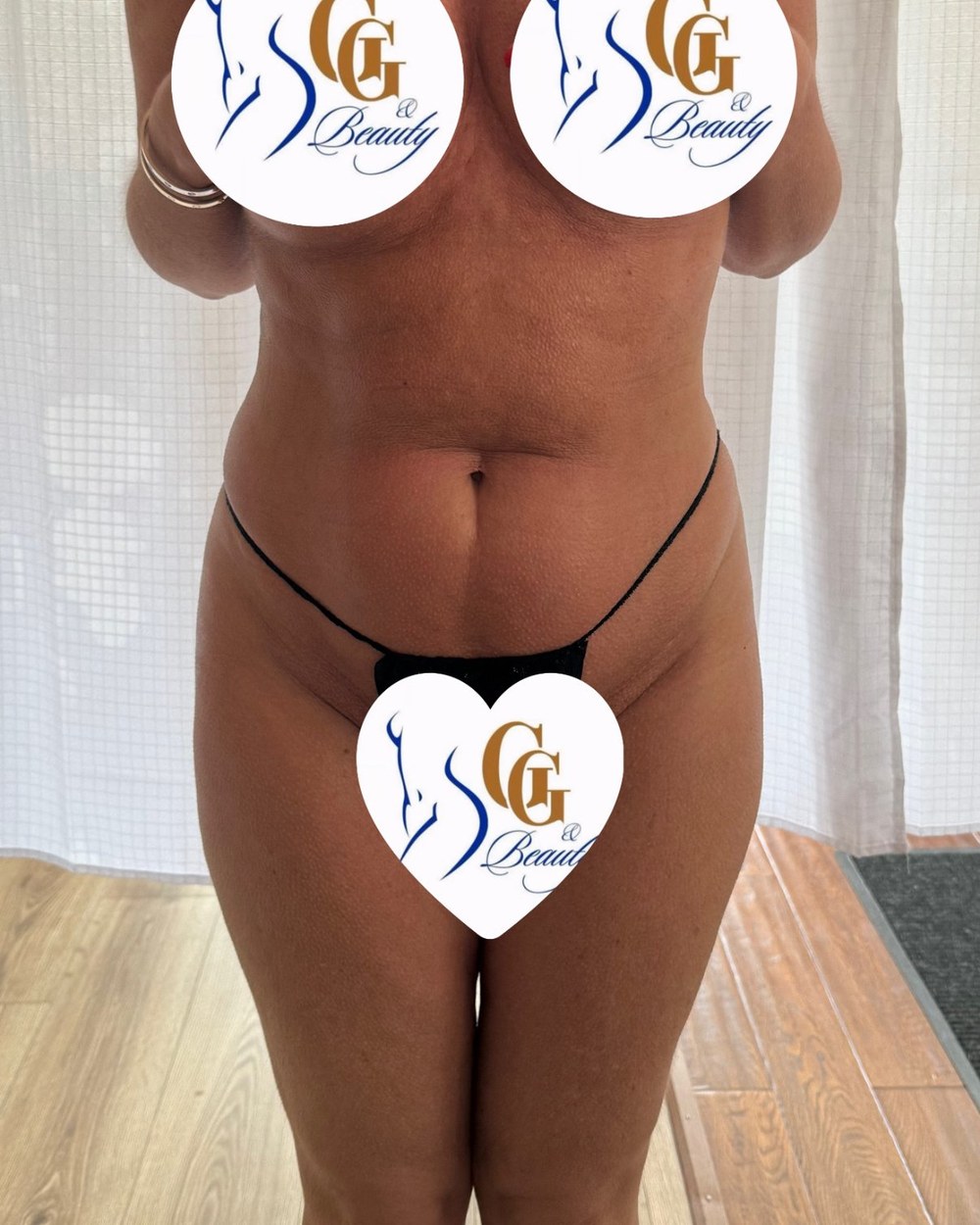 Real client after four Signature Sculpt sessions including radio frequency skin tightening