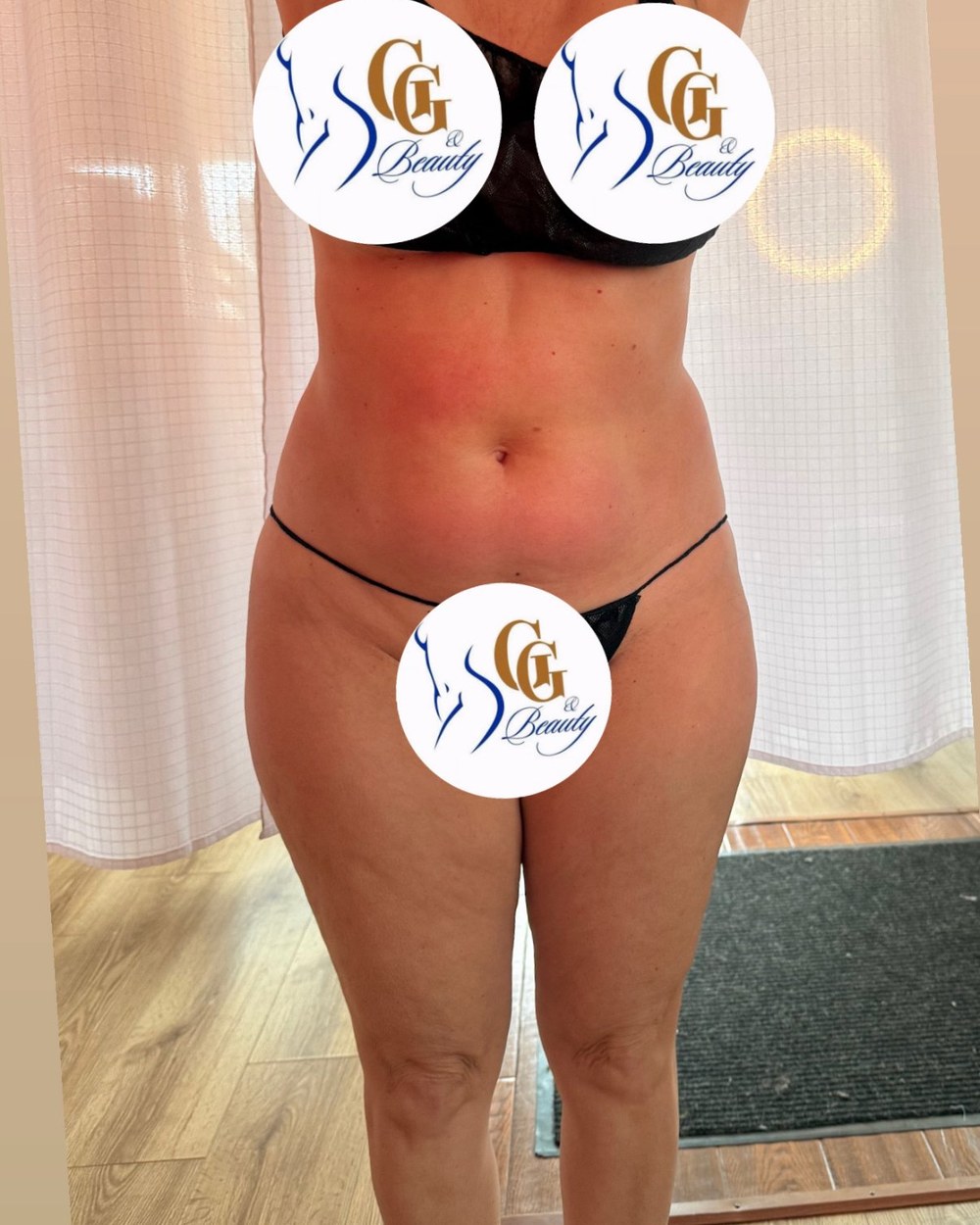Real client after one body sculpting session