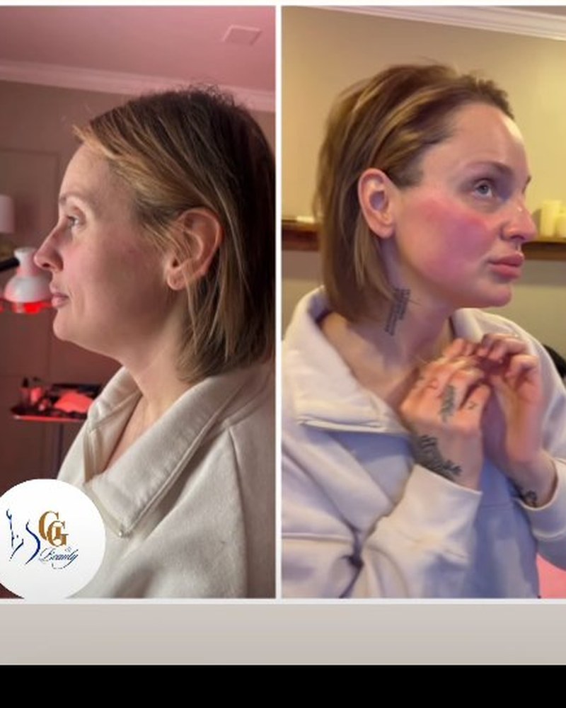 Plasma shower face and jawline before and after — 1 session