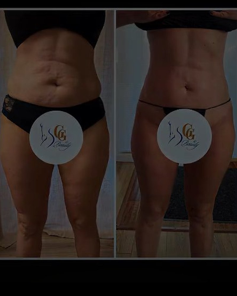 Body sculpting stomach before and after — package of 4
