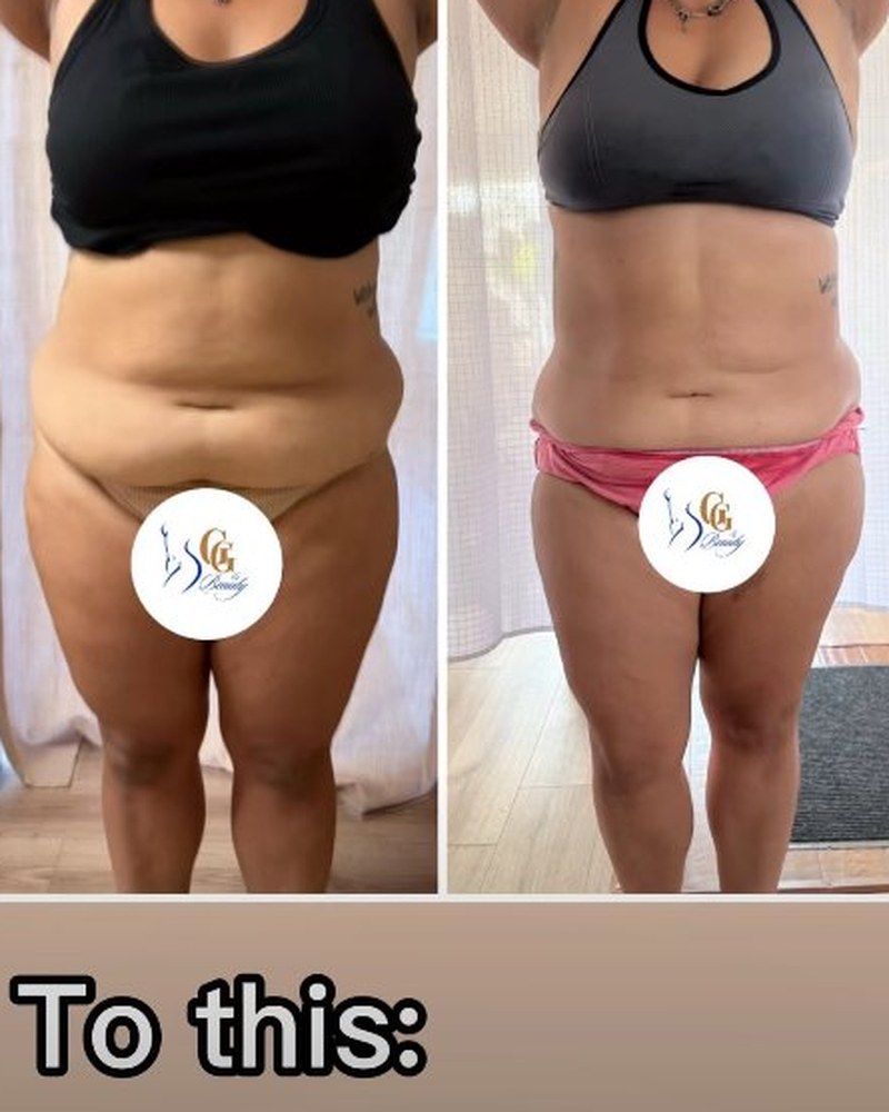 Body sculpting stomach before and after — 3 sessions