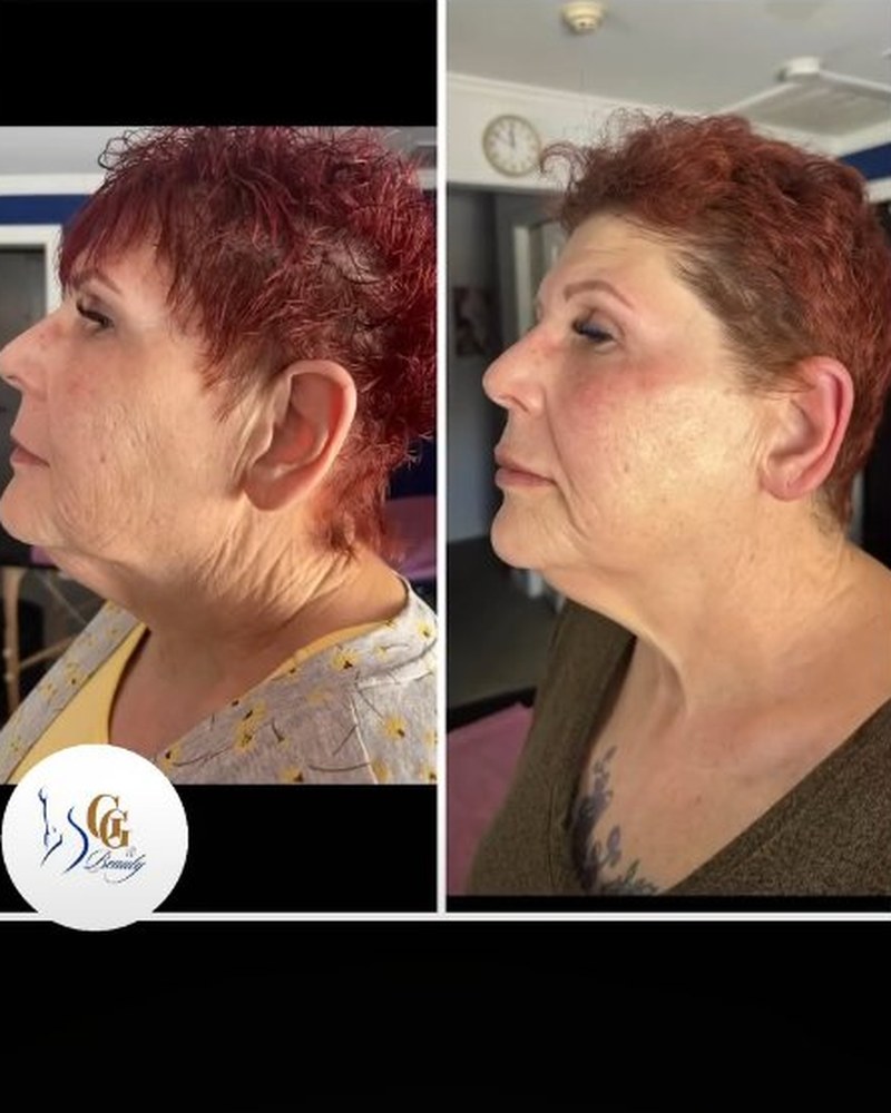 Plasma shower face and neck before and after — 4 sessions