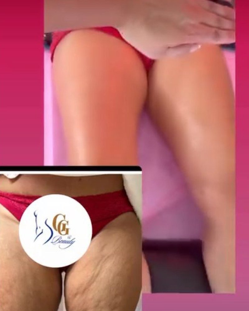 Body sculpting legs before and after — 4 sessions