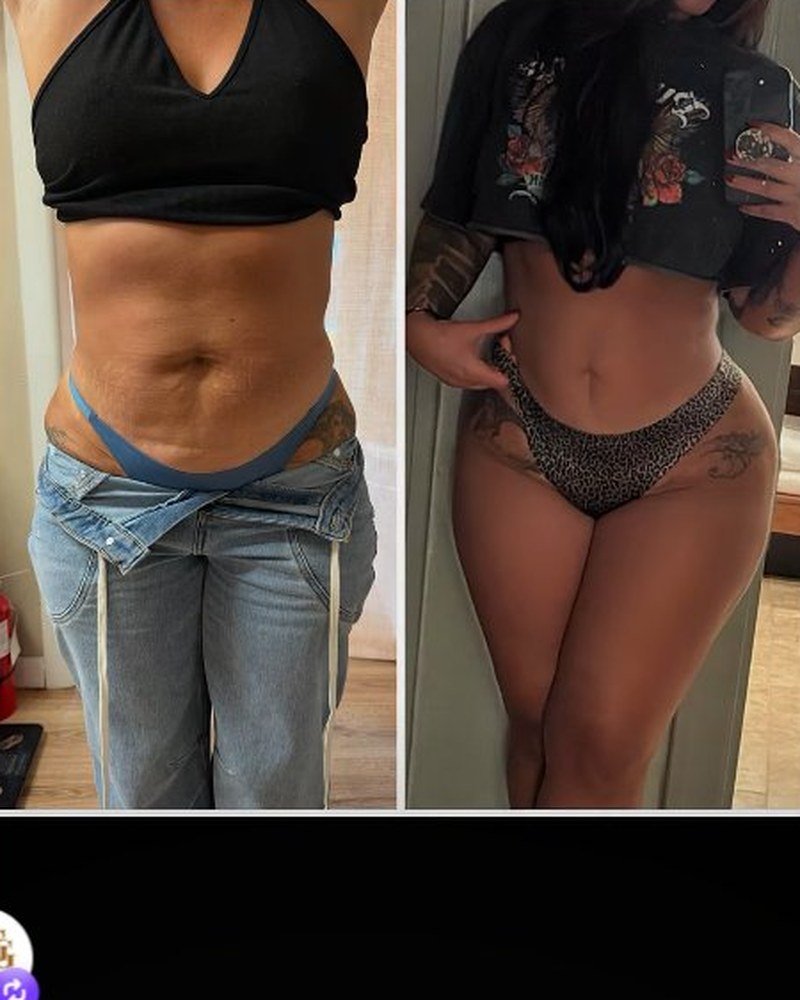 Body sculpting stomach before and after — 4 sessions
