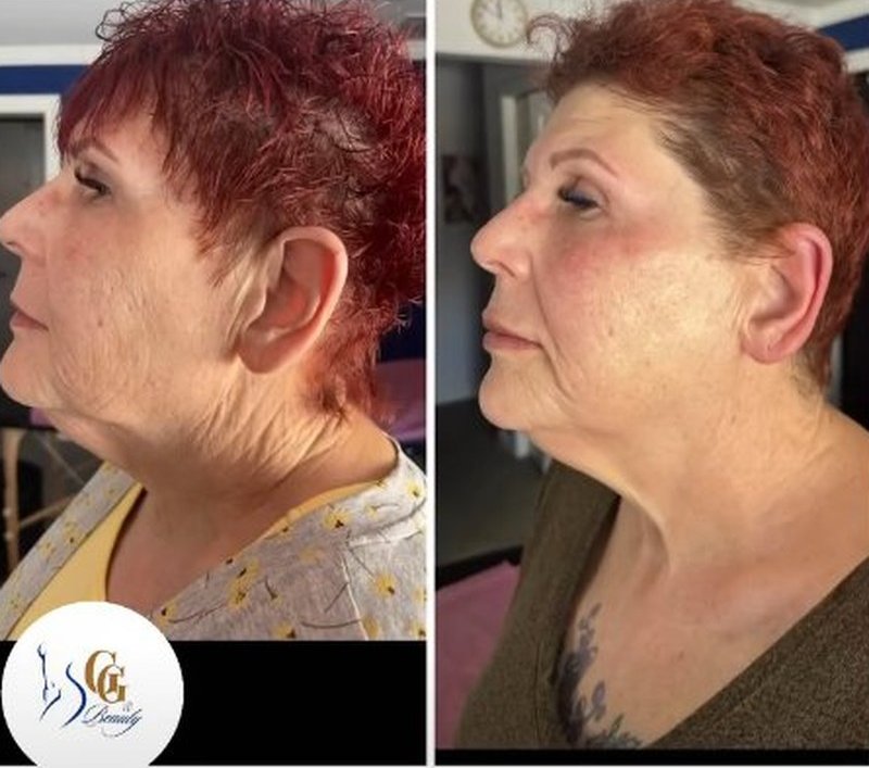 Face and neck before and after Plasma Showers, real client