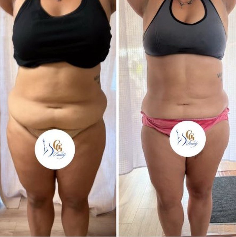 Stomach before and after body sculpting, real client
