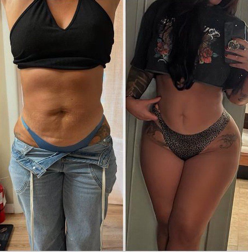 Stomach before and after body sculpting, real client